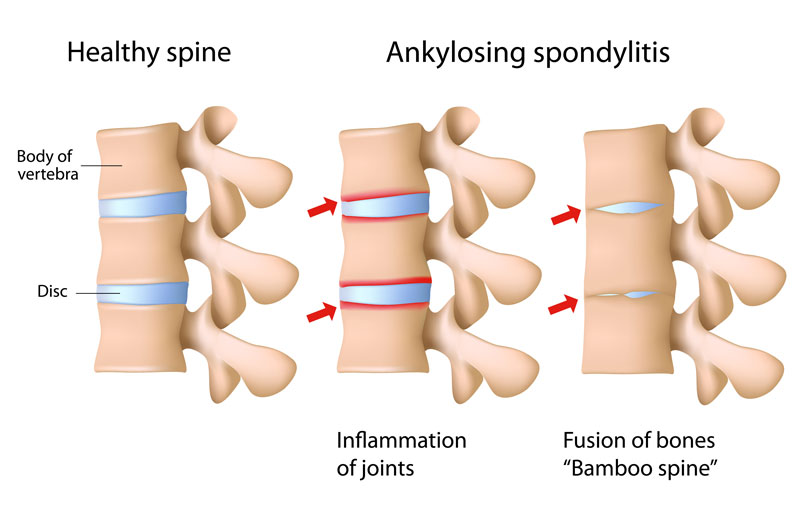 Ankylosing spondylitis of the spine