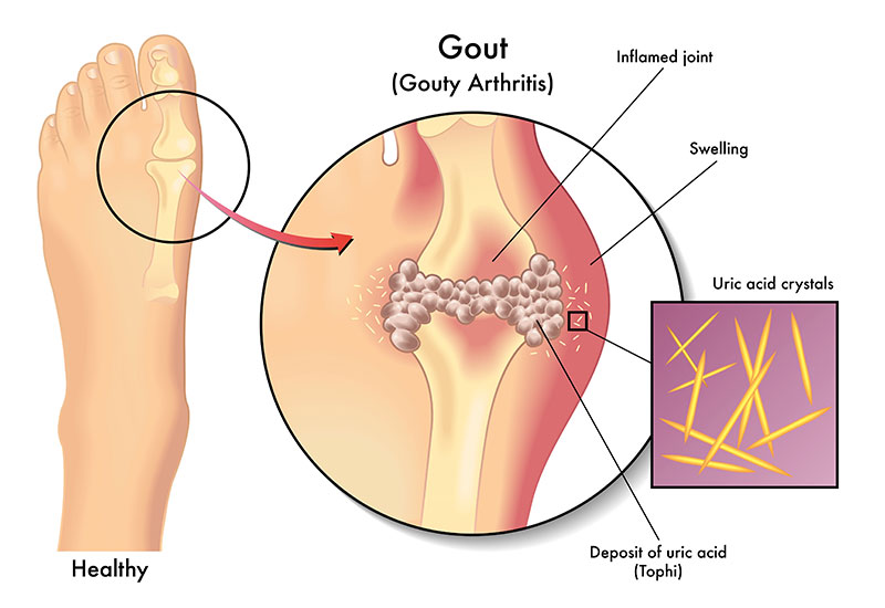 Diagram of Gout in toe joint