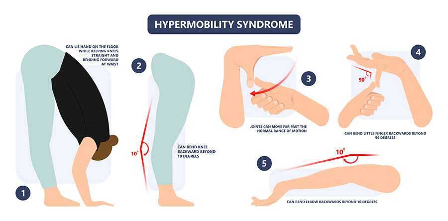 diagram of Ehlers-Danlos hypermobility test