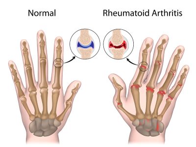 Rheumatoid Arthritis - Arizona Arthritis & Rheumatology Associates, P.C.