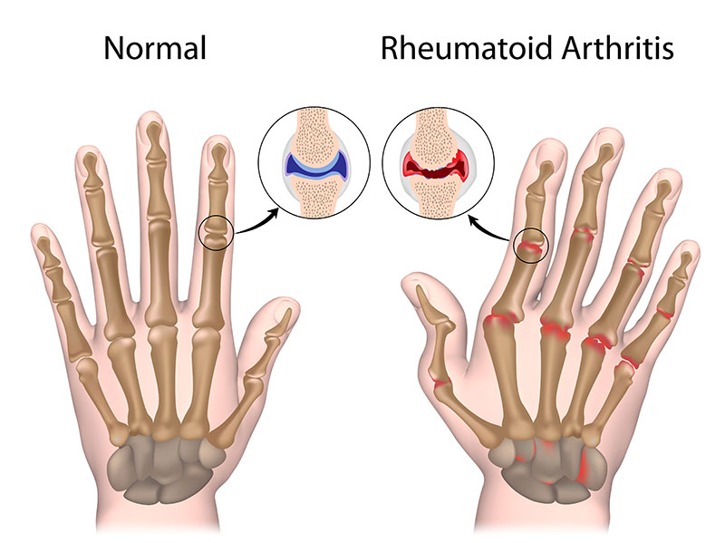 Rheumatoid Arthritis Arizona Arthritis And Rheumatology Associates Pc 