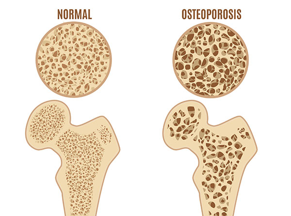 diagram of normal bone and osteoporosis bone