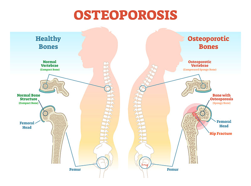 Osteoporosis Bone Health Clinic Arizona Arthritis Rheumatology Associates P C