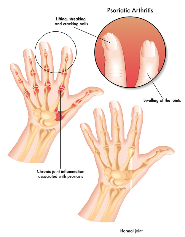 Symptoms of Psoriatic Arthritis